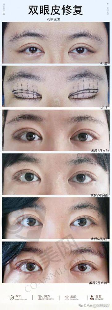 双眼皮修复项目有什么特色？