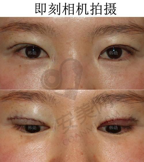 双眼皮修复后的感受是怎样的？
