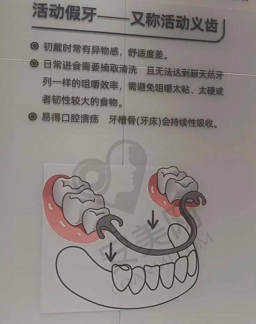 总结：深圳福民鼎植口腔全口假牙就诊体验