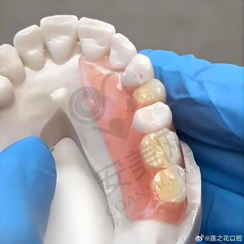 全口假牙的制作过程需要多久？