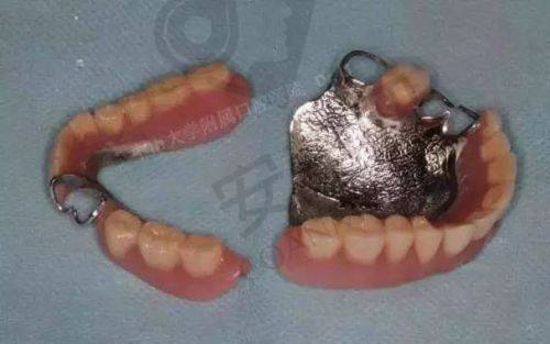 全口假牙的检查过程是怎样的？