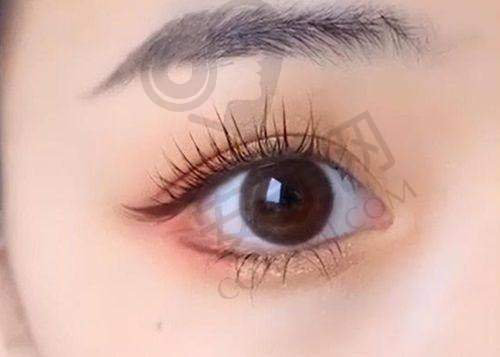 深圳艺星双眼皮整形的术后成效如何？