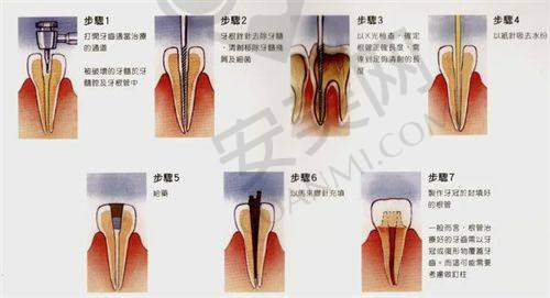 北京劲松口腔医院显微根管治疗的流程是怎样的？