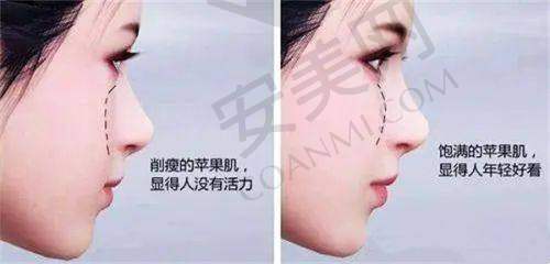 哪些人适合做7D半岛黄金超声炮？