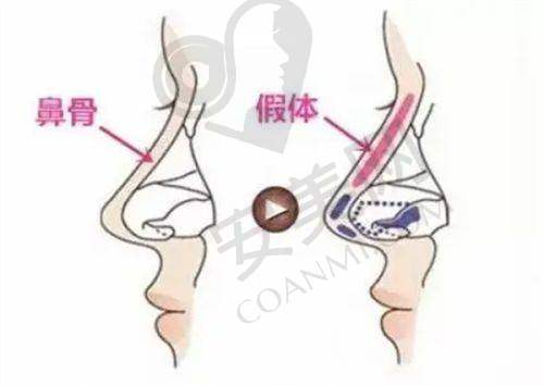 7D半岛黄金超声炮治疗过程是怎样的，需要注意什么？