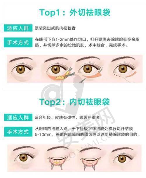 维密Ultra美眼的手术过程是怎样的？