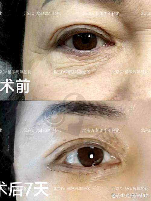 为什么选择苏州维多利亚进行维密Ultra美眼手术？