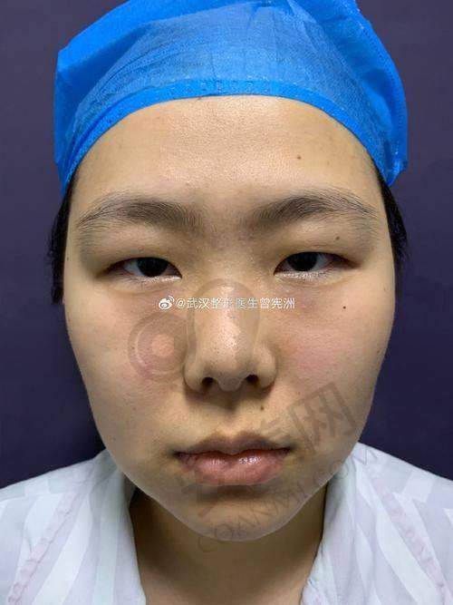 重庆华美眼部整形医生的口碑如何？