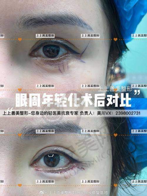 重庆华美眼部整形医生的成功实例多吗？