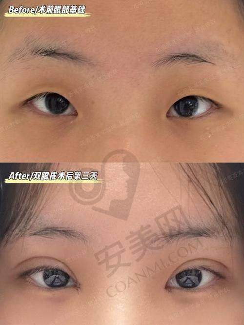 进行双眼皮修复需要注意什么？