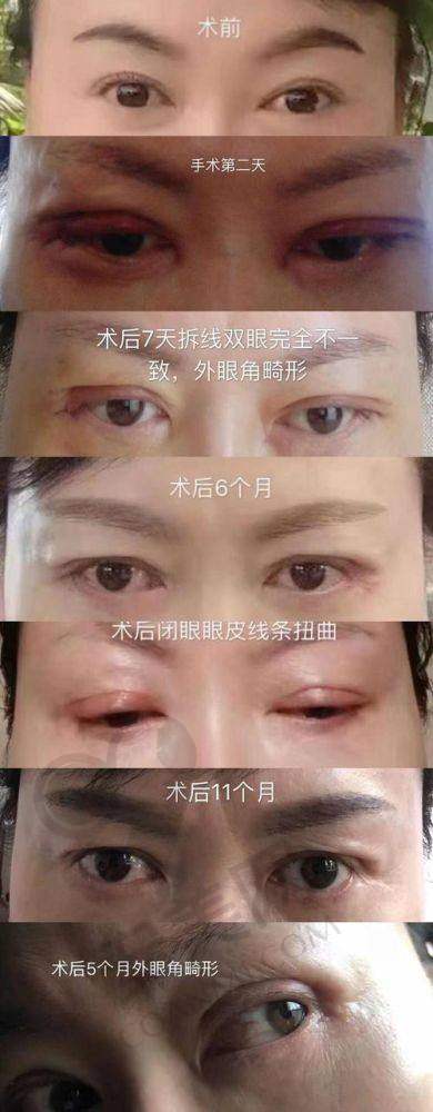 怎样预约重庆华美眼部整形医生？