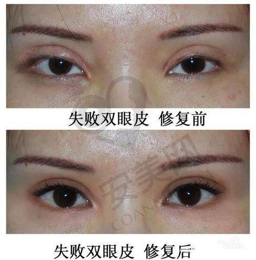 郑州杨丽美颜双眼皮修复与其他医院相比有什么独特之处？