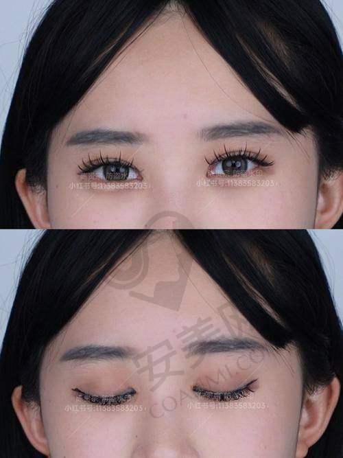 郑州杨丽美颜双眼皮修复的优势在哪里？