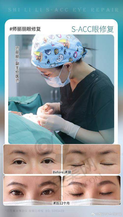 为什么需要双眼皮修复？
