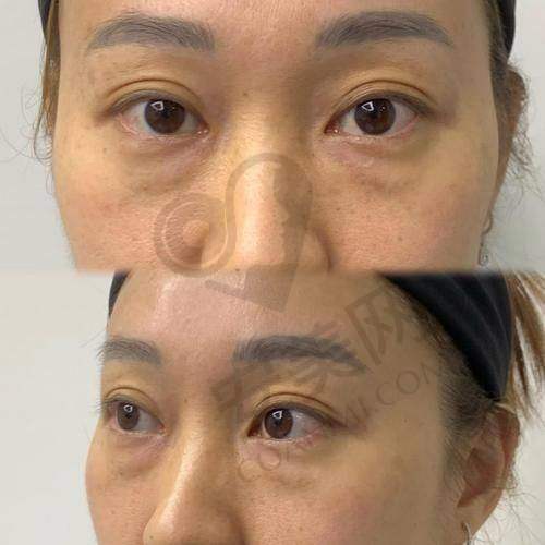 郑州田国静修复眼袋费用与成效的关系是怎样的？