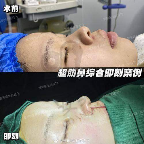鼻综合整形的价格是如何确定的？