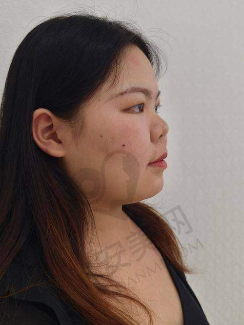 重庆华美医院鼻综合整形的成功实例多吗？