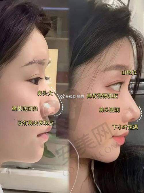 鼻综合整形的修复过程是怎样的？