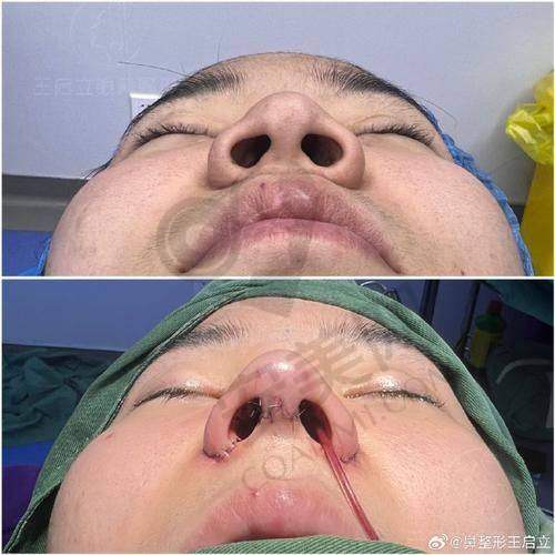 什么是鼻综合整形？