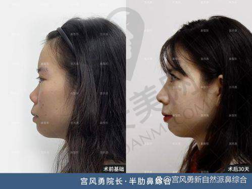 鼻综合整形有哪些注意事项？