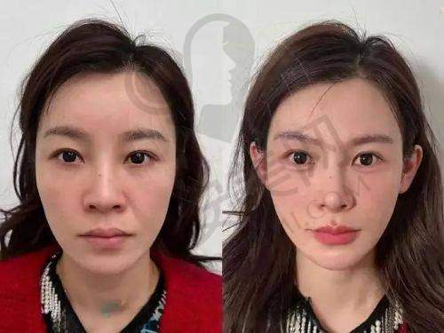为什么选择台州艺星整形医院注射乔雅登玻尿酸？