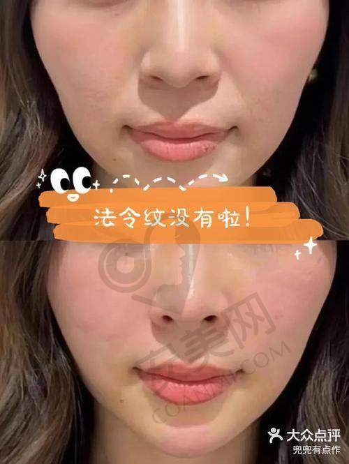 玻尿酸填充法令纹的成效能维持多久？