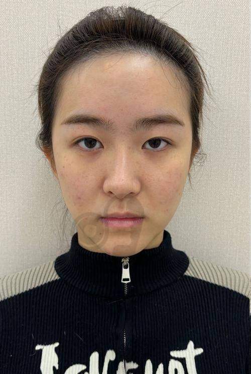 乔雅登玻尿酸注射的成效如何？