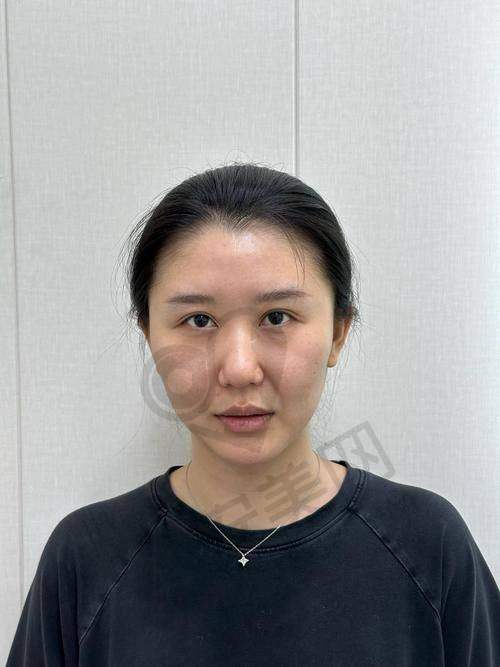 注射乔雅登玻尿酸的过程是怎样的？