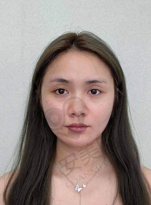 总体来说，在台州艺星整形医院注射乔雅登玻尿酸的感受如何？