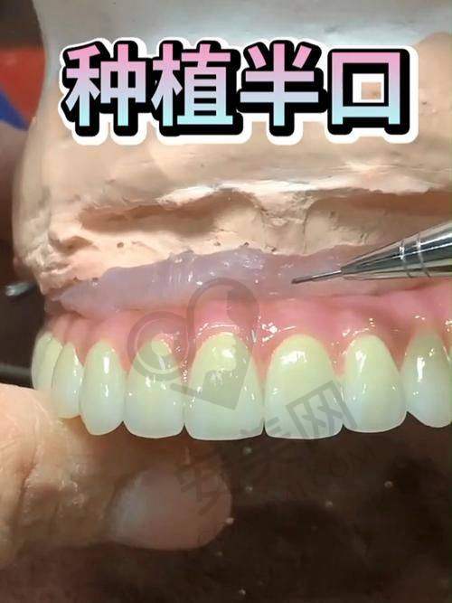 为什么选择厦门登特口腔医院进行半口种植牙？