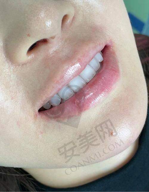 什么是瓷牙齿贴面美白？