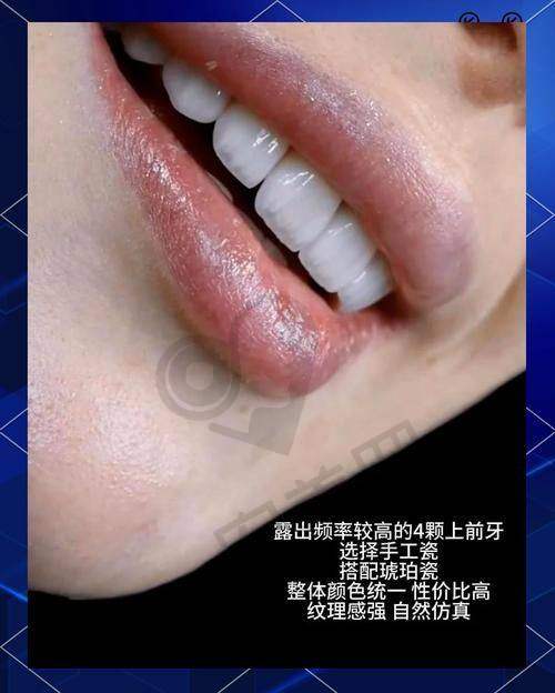 瓷牙齿贴面美白后需要注意什么？