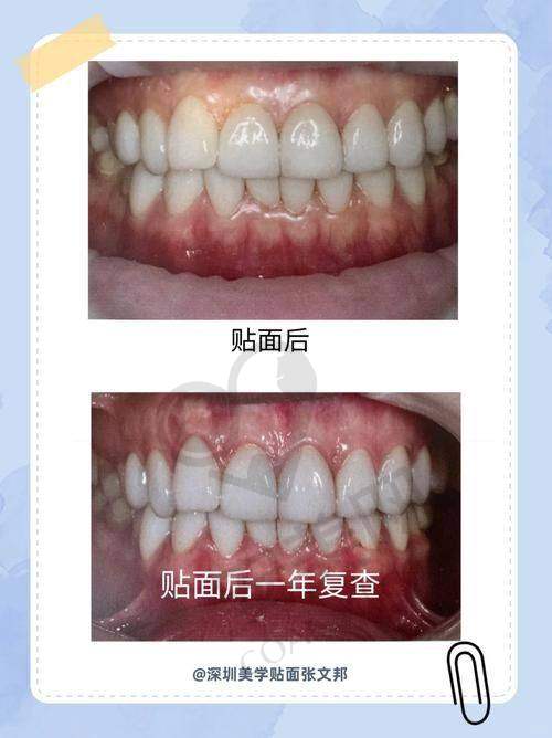 牙齿贴面美白后成效如何？
