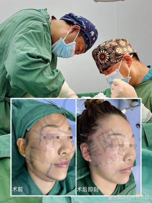 贺焕焕医生的拉皮提升技术特色在哪里？