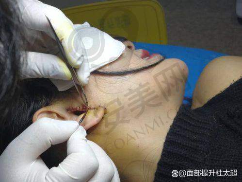术后修复阶段，情况如何？