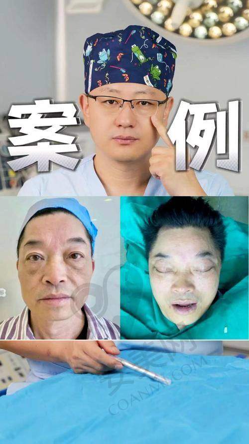 这次拉皮提升经历，给我带来了哪些改变？
