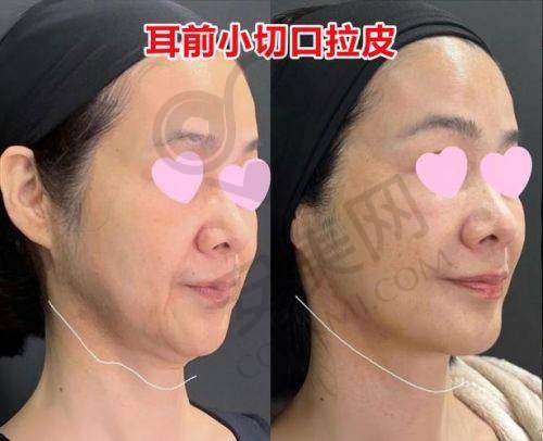 术后5年数据：下垂率与满意度实证