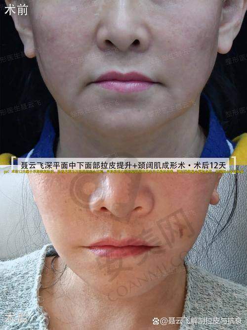 如何选择适合自己的拉皮提升方式？
