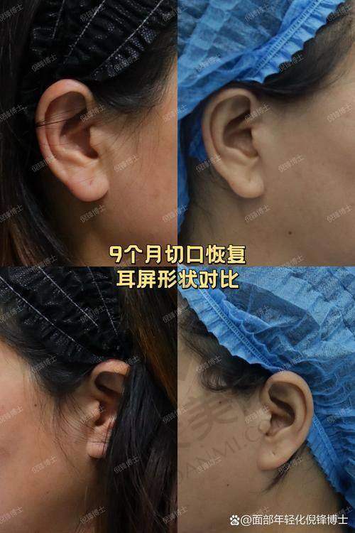 拉皮提升手术的过程是怎样的？