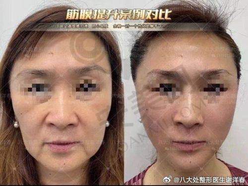 乌鲁木齐华美整形拉皮提升适合哪些人群？