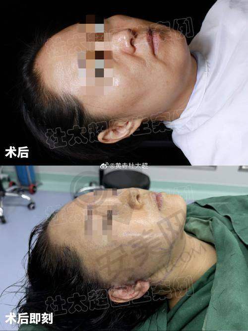 拉皮提升手术有哪些风险？