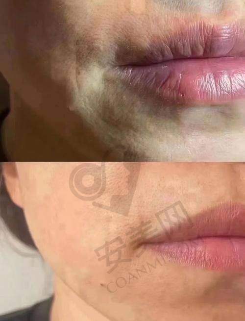 如何预约宝鸡晶肤医院的口周抗衰项目？