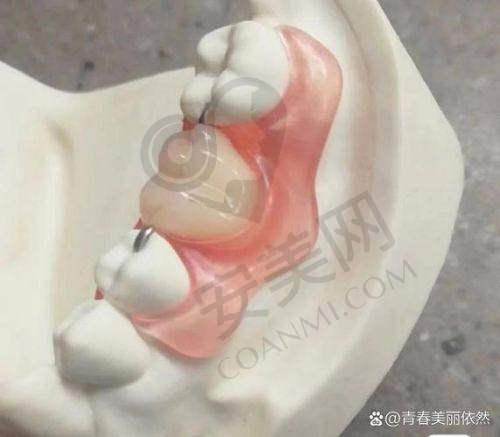 半口活动义齿价格为何900元起？
