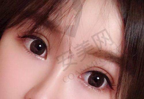 衡水唯美做双眼皮，医生团队靠谱吗？