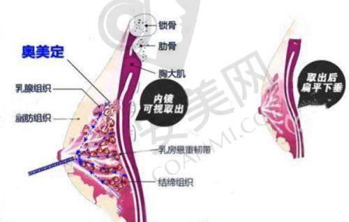 什么是胸部奥美定？它有哪些危害？