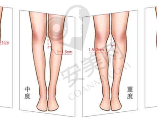 胡俊杰医生在人中整形方面有哪些独特技术？