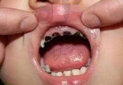 牙齿矫正收费贵吗？