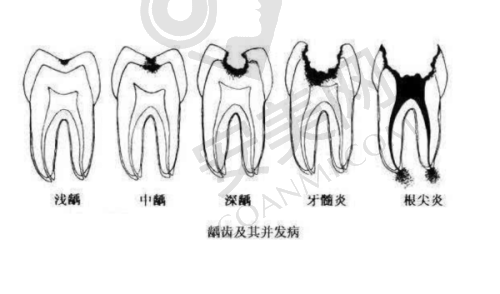 呼和浩特华医口腔医院智齿龋齿拔牙费用为何较高？