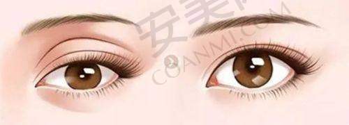 杭州艺星双眼皮 + 开眼角术后修复情况如何？