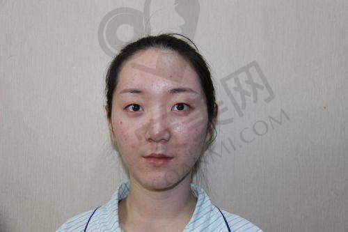 衡水唯美做双眼皮，价格合理吗？